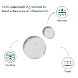 Be Soulfull Acne Control Serum for Oily & Acne-prone Skin| Treats Acne & Hyperpigmentation | 30ML